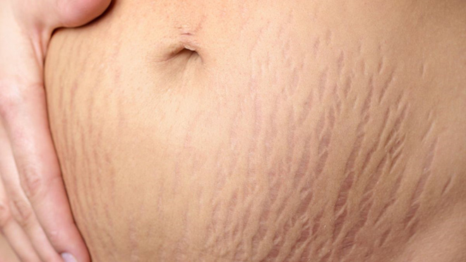 Rạn da ở bụng thường gặp ở phụ nữ sau sinh